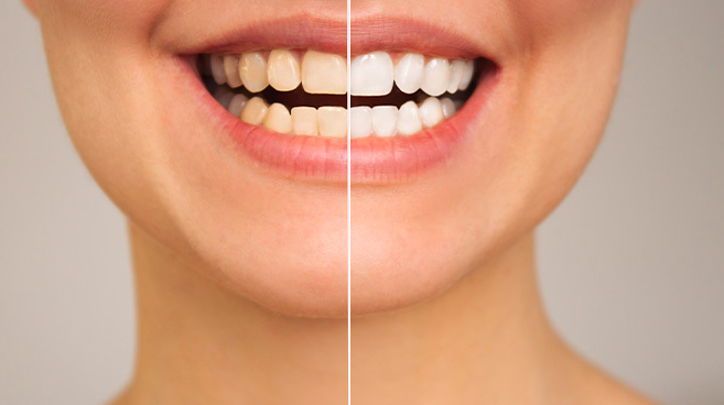 teeth whitening dubai